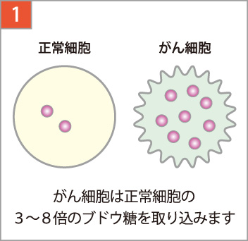 がん細胞は正常細胞の3～8倍ブドウ糖を取り込みます