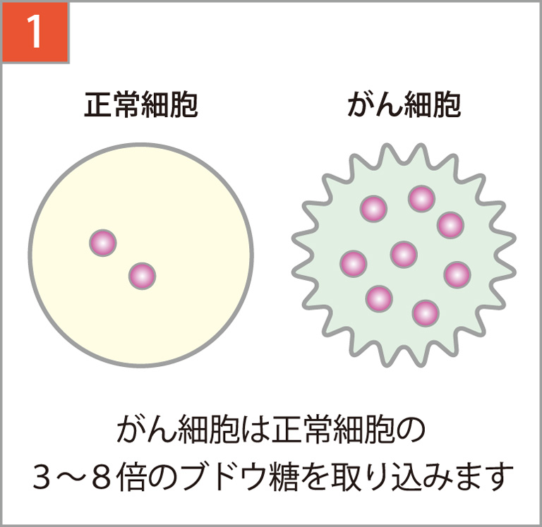 がん細胞は正常細胞の3～8倍ブドウ糖を取り込みます