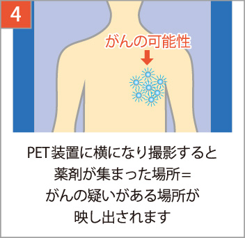 PET装置で撮影すると薬剤が集まった場所が映し出され、がんの有無・大きさがわかります