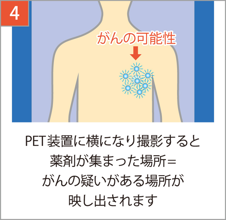 PET装置で撮影すると薬剤が集まった場所が映し出され、がんの有無・大きさがわかります