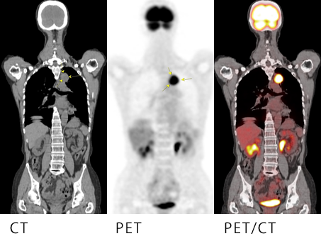 PET検査の症例画像